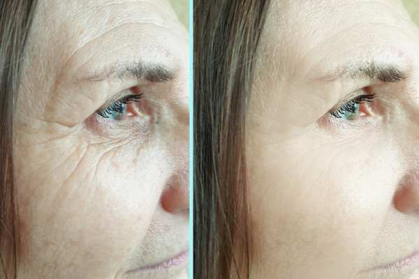 Why Do People Choose HIFU for a Non-Surgical Facelift? 4 How long can HIFU results last Berkhamsted?