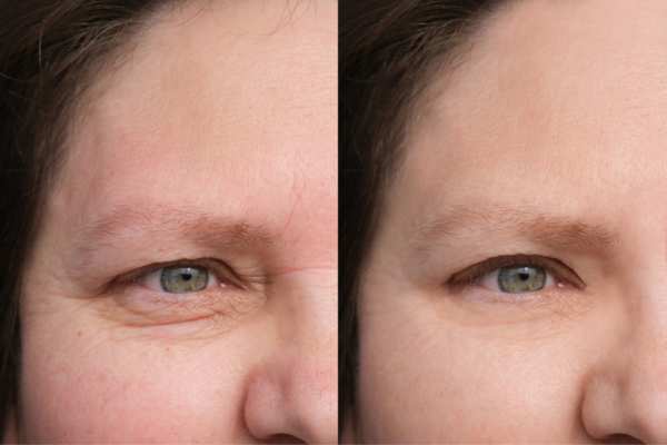 HIFU vs Botulinum Toxin: Understanding the Differences 4 How long do HIFU results last Berkhamsted?