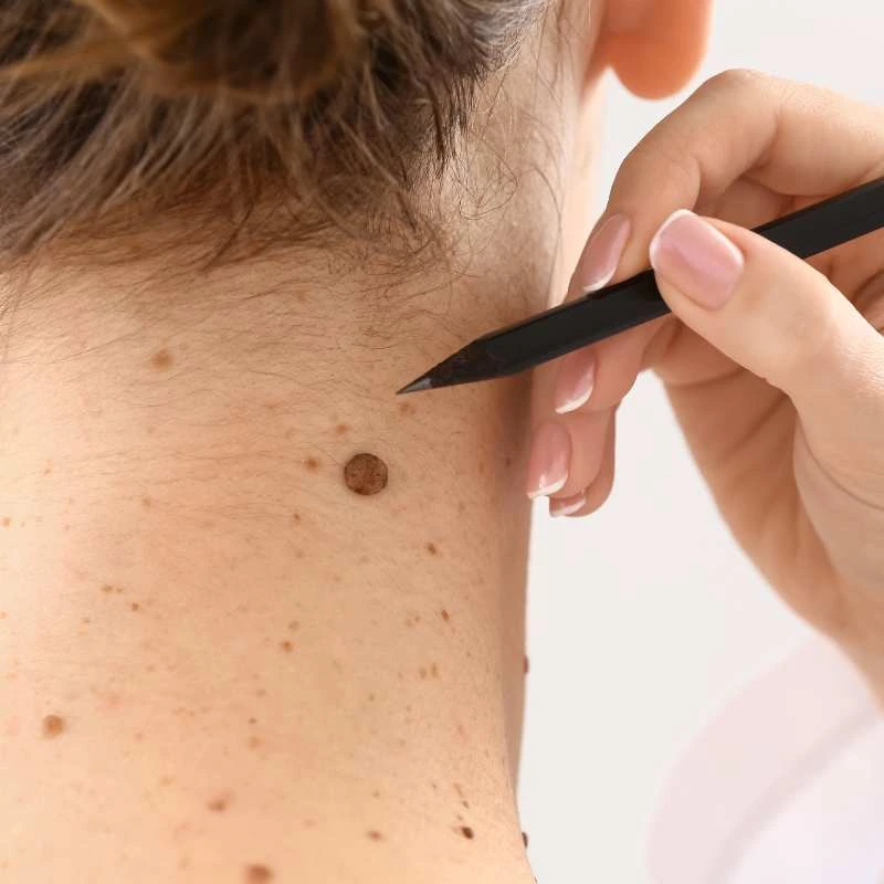 How to Support Your Body During Pregnancy for Faster Postnatal Recovery 5 See our lesion removal prices Berkhamsted - call today for a free quote