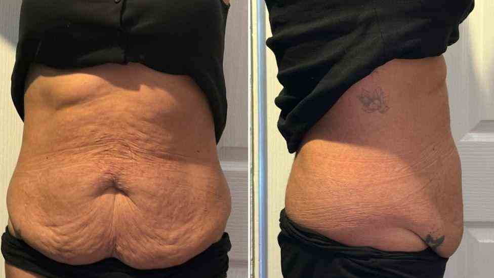 Lost the Weight but Not the Loose Skin? What You Should Know 1 Is It Definitely Loose Skin Berkhamsted?
